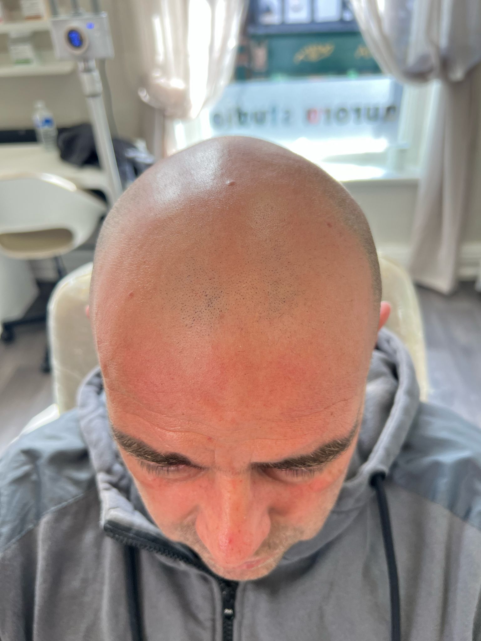 Before SMP Treatment